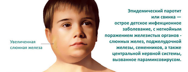 При заболевании свинкой, поражаются преимущественно железистые ткани заушных лимфоузлов