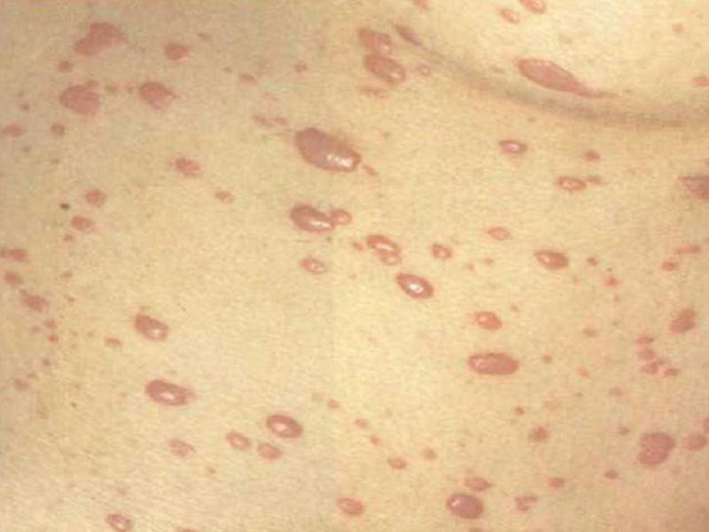 Сифилис - это сложное венерическое заболевание, которое в случае отсутствия адекватного лечения может привести к смерти больного