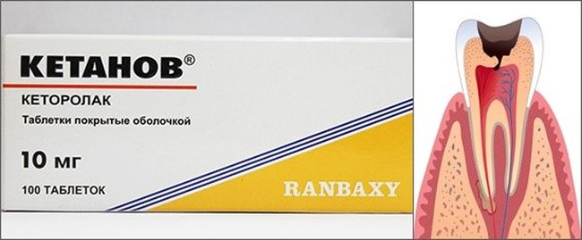 Кетанов - отличное средство для снятия зубной боли