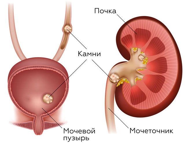 Цистон выводит все посторонние образования из почек, не позволяя зародиться новым конкрементам, тем самым оказывает не только лечебное воздействие, но и проводит профилактику мочекаменной болезни