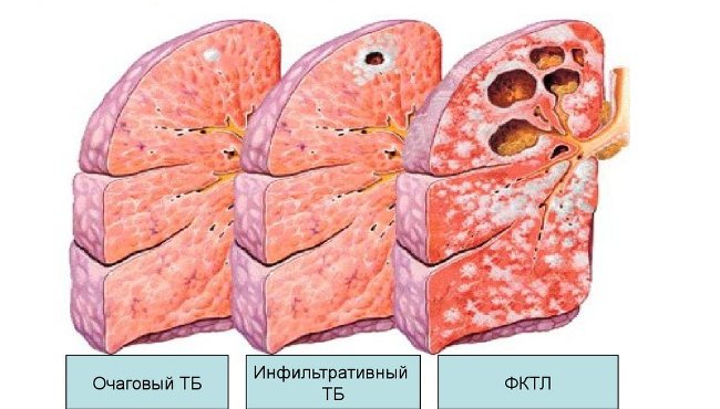 Формы туберкулеза легких