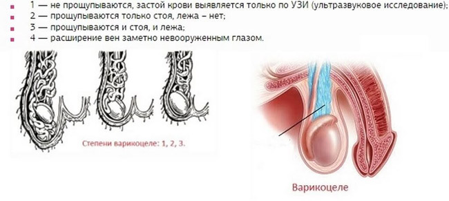 Степени варикоцеле
