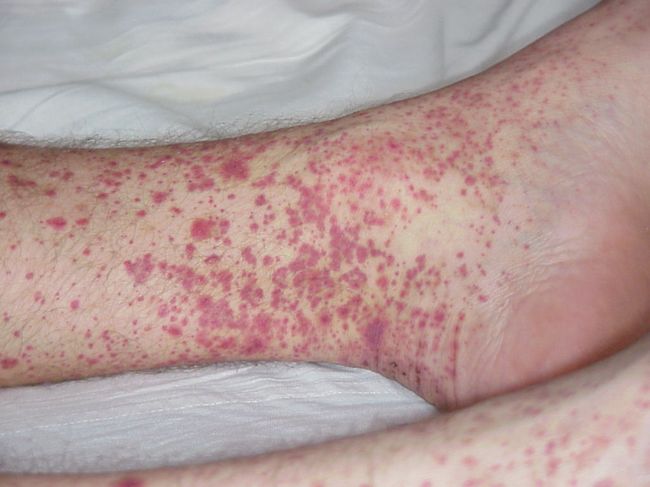 Проявление заболевания васкулит на ноге