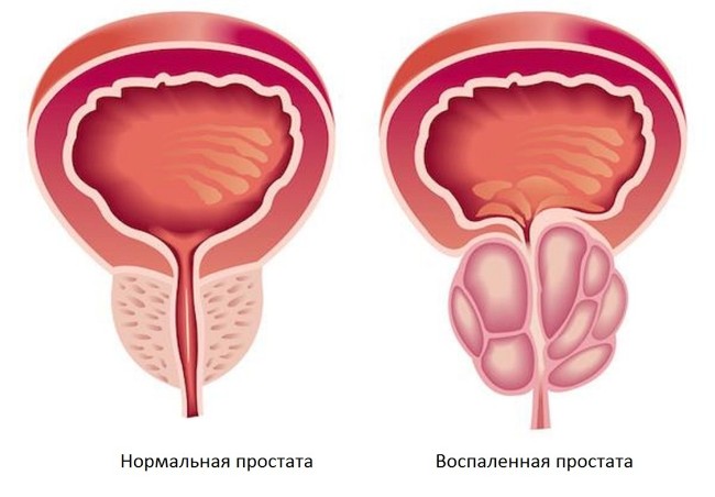 Витапрост применяется для лечения острого и хронического простатита