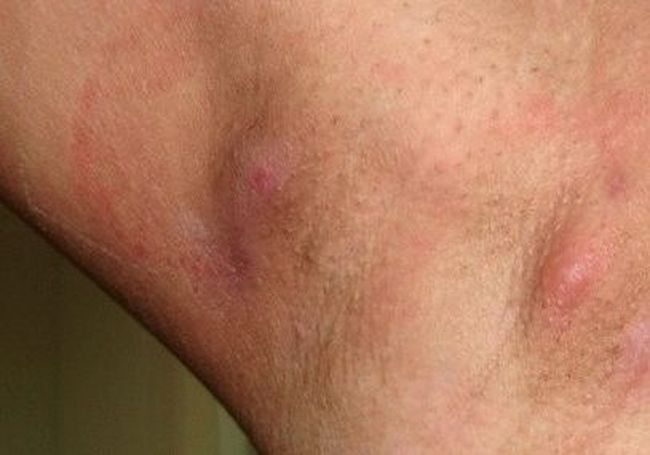 Так выглядит воспаление лимфатических узлов под мышкой, как на фото примере.