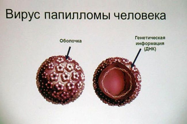 Инфекция, вызванная вирусом папилломы, представляет собой бородавки (кондиломы) и относится к группе вирус-инфекционных заболеваний, которые характеризуются возникновением на кожном покрове