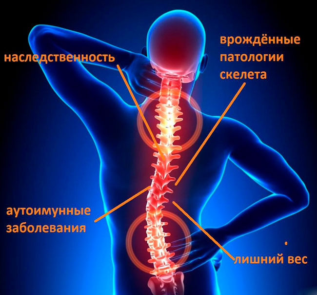 Защемление нерва может возникнуть при сдавливании нервных корешков, которые отходят от спинного мозга, соседними позвонками, межпозвонковыми дисками, мышцами и различными патологическими образованиями