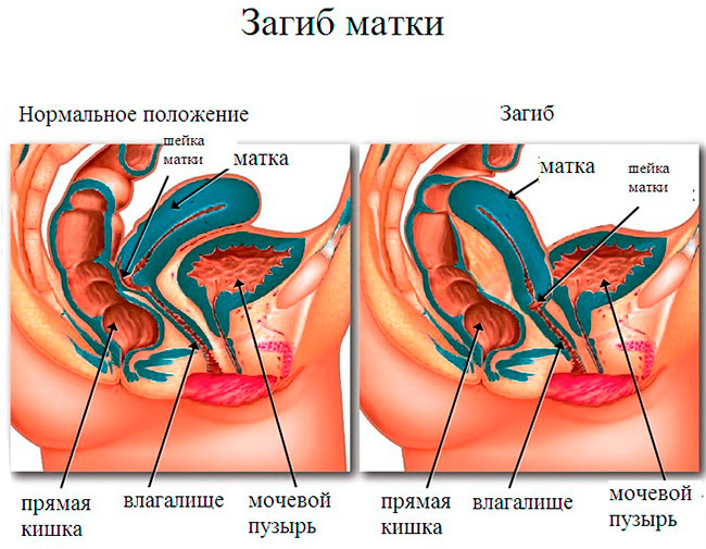 Нормальное анатомическое положение матки специально предусмотрено природой, чтобы на пути сперматозоидов не было никаких препятствий, поэтому из-за загиба многие женщины не могут забеременеть