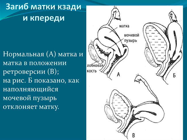 Если патологический загиб матки был вызван воспалением, то необходим прием антибиотиков, противовоспалительных средств и физиотерапия