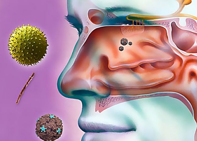 Утренняя заложенность носа без соплей - достаточно распространенное явление, в течение всего дня нос дышит, но к утру его закладывает. Когда такая аномалия становится хронической, необходимо обратиться к врачу, т.к. возможны осложнения, в частности возникновение гайморита