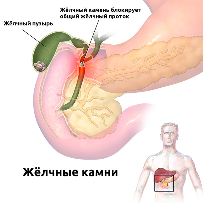 Переедание и сидячий образ жизни могут быть причинами возникновения холецистита