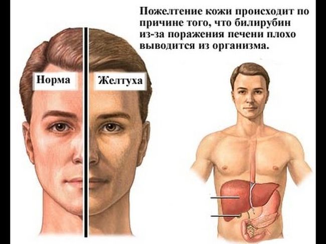 Желтуха - это заболевание, которое невозможно не заметить