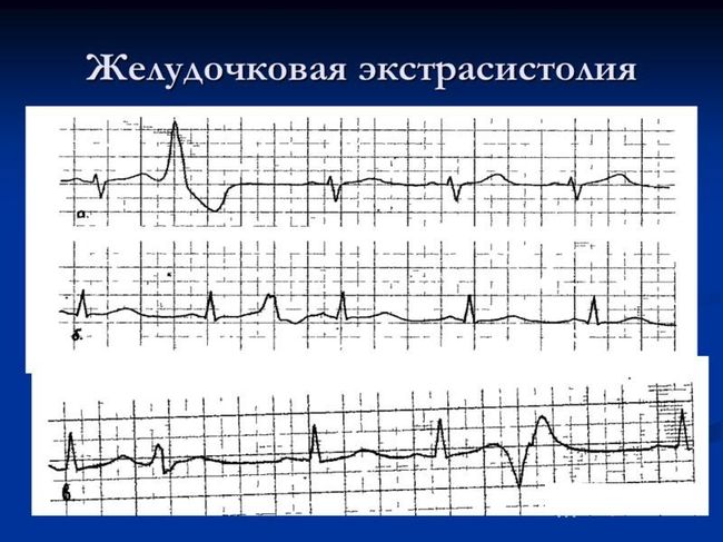 Желудочковая экстрасистолия - это аритмия, возникающая под влиянием нервных импульсов