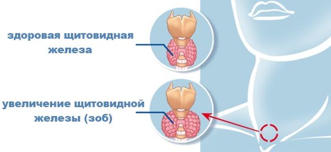 Здоровая и увеличенная щитовидная железа