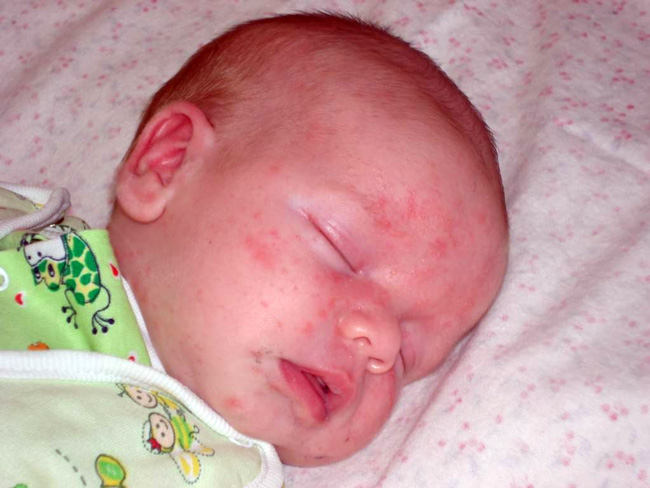 Золотистый стафилококк — это бактерия, которая устойчива к антибиотикам пенициллинового типа, выделяющая сильнейший токсин, и неблагоприятно действующая на организм человека