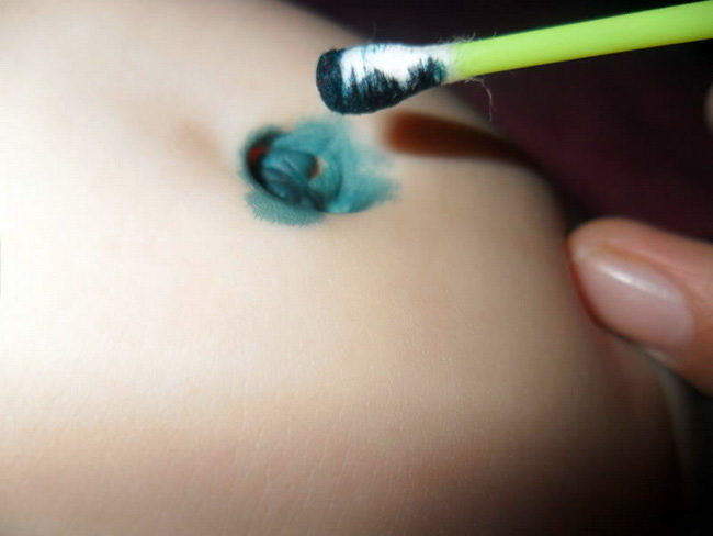 Пупочная ранка - один из путей заражения новорожденного золотистым стафилококком